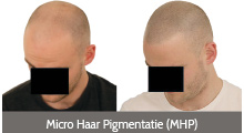 Micro Haar Pigmentatie (MHP)